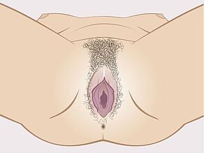 Okaleczenie żeńskich narządów płciowych - typ 2: usunięcie warg sromowych.