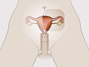 Un hombre eyacula dentro de la vagina de una mujer. Los espermatozoides nadan hacia el óvulo maduro.