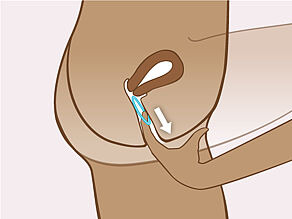 Para retirar el anillo introduzca un dedo dentro de la vagina y enganche el anillo. Tire suavemente de él hacia afuera.