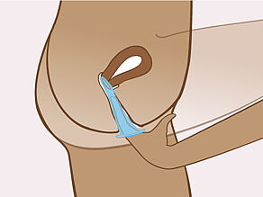 Vendosni 1 gisht brenda prezervativit dhe shtyni unazën lart sa më shumë të jetë e mundur.