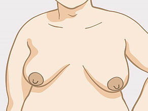 Distintas formas de senos: senos medianos en forma de pera (ligeramente ovalados). 