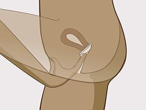 Introduzca el diafragma profundo en la vagina, sobre la entrada del útero. El cuello uterino debe estar cubierto.
