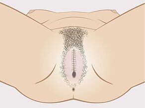 Okaleczenie żeńskich narządów płciowych - typ 3: zszycie warg sromowych.