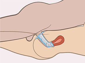 Pierścień zewnętrzny utrzymuje prezerwatywę na miejscu podczas odbywania stosunku płciowego. 