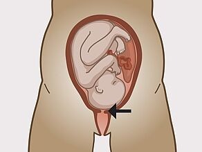 The cervix, the entrance to the uterus, is opening up during contractions.