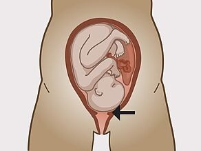 Le col de l’utérus s’élargit. 