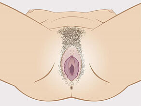 Mutilarea genitală a femeilor - Tipul 1: extirparea clitorisului.