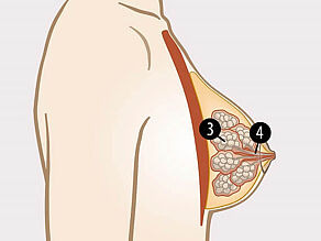 Parts of a breast inside are: 3. mammary glands, 4. ducts.
