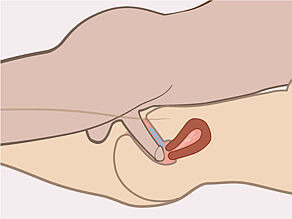The ring stays in place when having sexual intercourse. You can remove the vaginal ring during sexual intercourse, but you need to insert it again within 3 hours.