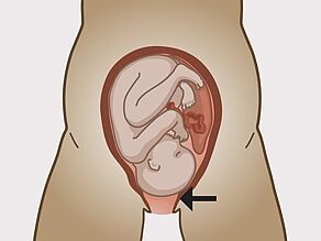مدخل الرحم متسع بقدر كاف يسمح بولادة الطفل.