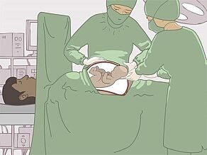 Le bébé naît souvent par césarienne.