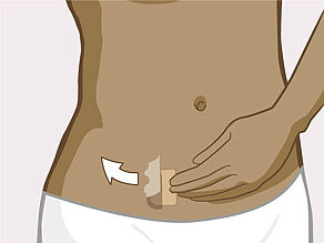 Aplicați suprafața adezivă a plasturelui pe piele și îndepărtați restul protecției. Apăsați ferm deasupra plasturelui pe piele. 