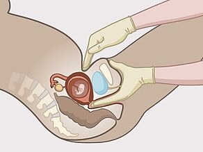 Detaliu al unui examen vaginal: medic care introduce câteva degete în vagin pentru a vedea dacă s-a dilatat deja colul uterin. Acesta/aceasta verifică și poziția uterului din exterior. 