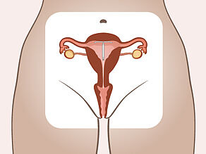 Sterilet montat în uter. 2 fire scurte vizibile în partea de sus a vaginului, în afara uterului.