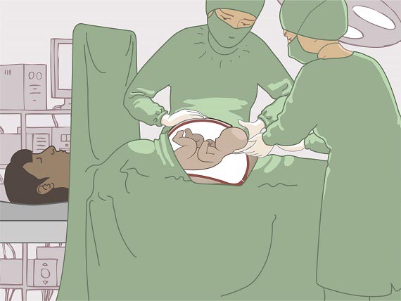 Operaţia de cezariană (naşterea chirurgicală) | Zanzu