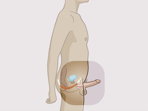Reeducare perineală UROSTIM (incontinență urinară) - OsteoKinetoMedica