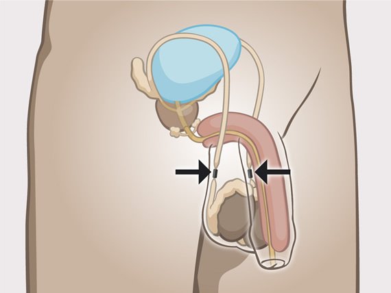 Bei männern sterilisation